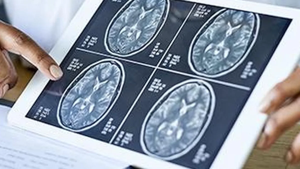 A diagram of the brain with a blood clot